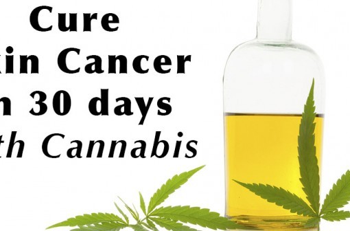 Skin Cancer Cured in 30 Days with Cannabis