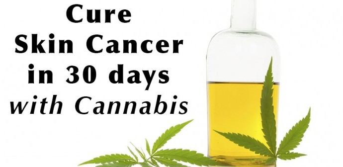 Skin Cancer Cured in 30 Days with Cannabis