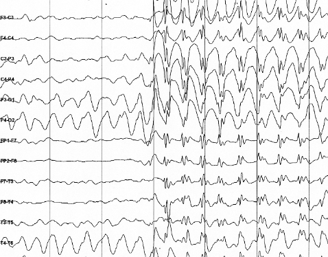 Can medical marijuana effectively treat childhood epilepsy?